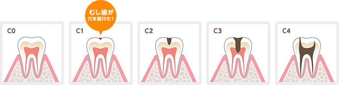 C0からC4と呼ばれる虫歯の段階。C1でむし歯が穴をあけます