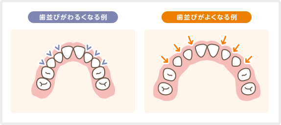 歯並びがわるくなる例・よくなる例