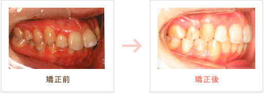 矯正前後のちがい