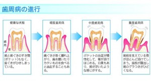 歯周病　3
