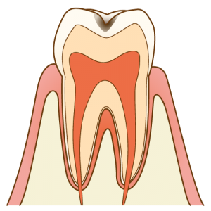 cavity001